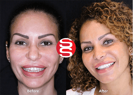 Porcelain Veneers